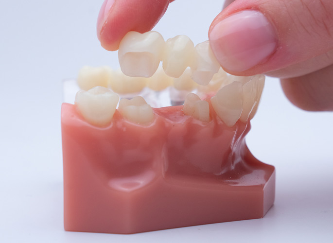 Model of teeth with a hand putting a bridge in place